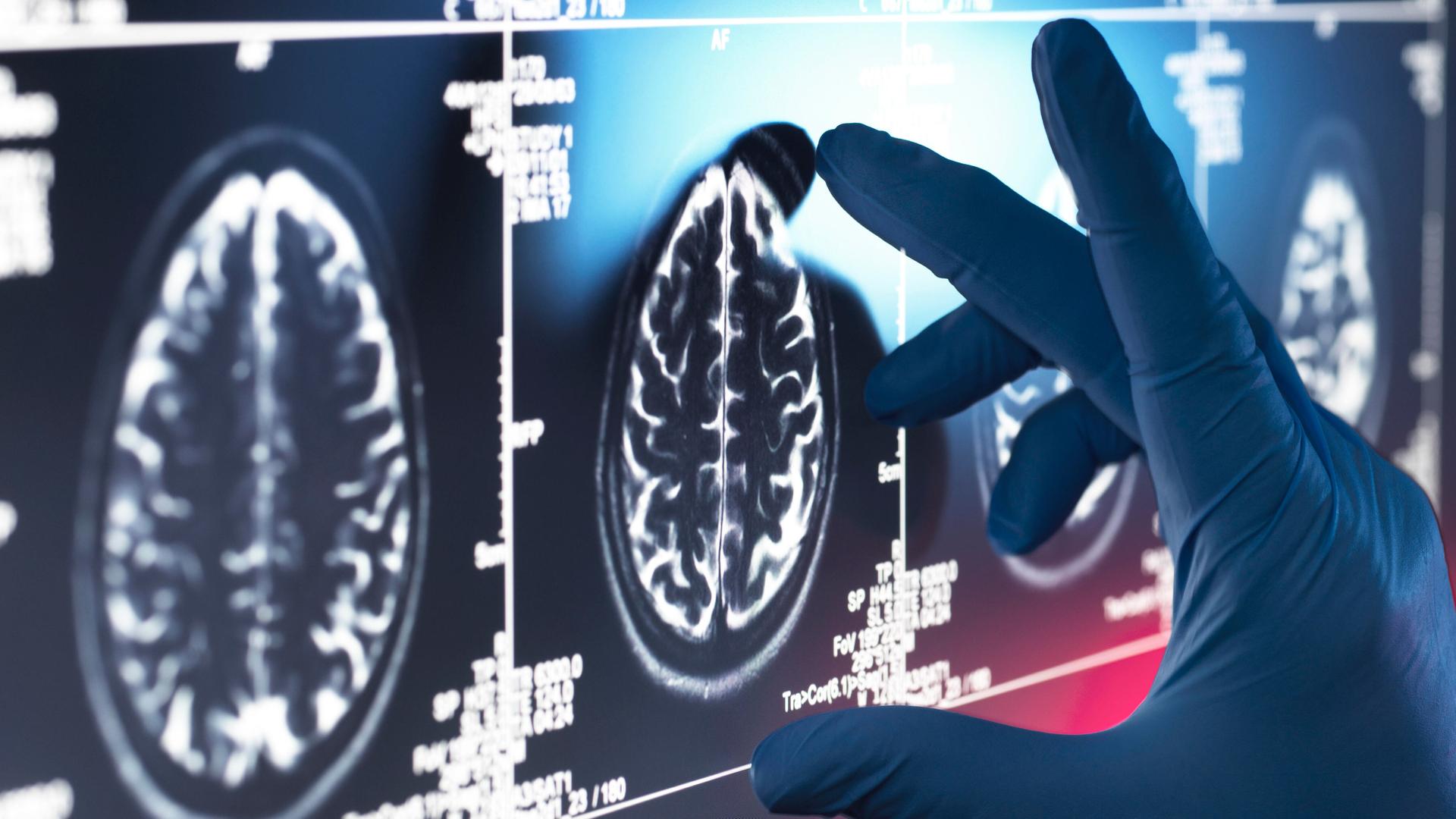 Eine Hand, die einen medizinischen Handschuh trägt, misst die Größe eines Gehirn, das auf einem CT-Scan zu sehen ist. 